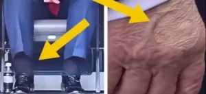 Donald Trump Diagnosed with Chronic Venous Insufficiency