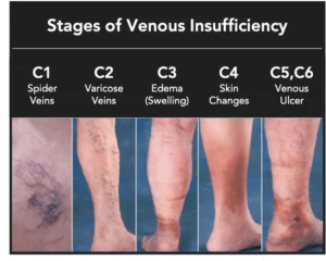 Donald Trump Diagnosed with Chronic Venous Insufficiency